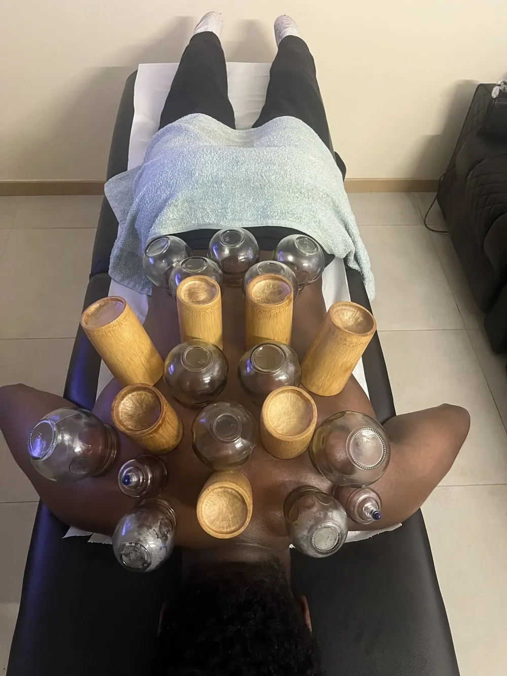 Cupping / Hijama